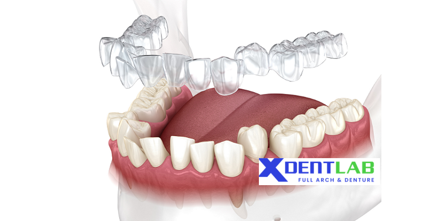 introduce Clear aligner supplier in vietnam