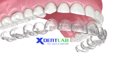 Custom orthodontic clear aligners