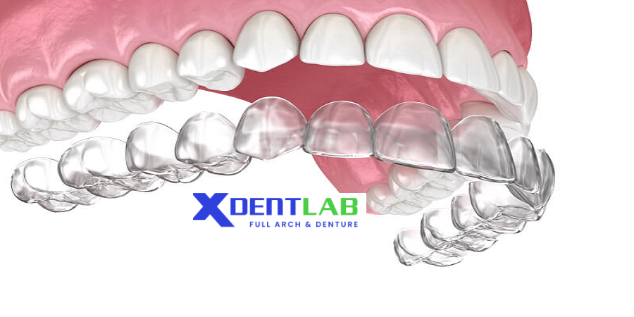 Custom orthodontic clear aligners